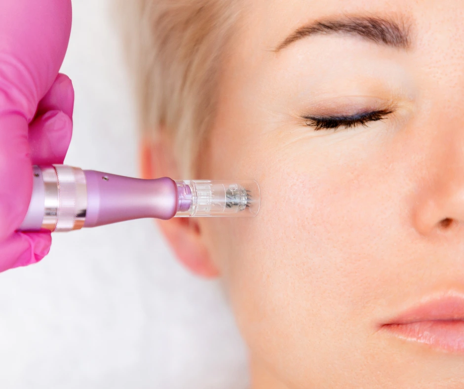microneedling gesicht